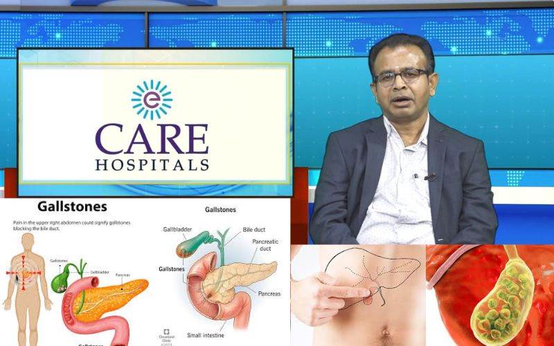  گالسٹونز( پتےکی پتھری) — ایک خاموش مگر سنگین بیماری